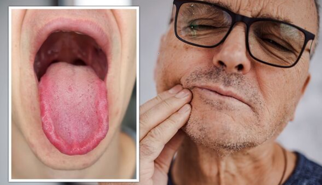 Bệnh tuyến giáp có thể gây ra hội chứng bỏng rát miệng?